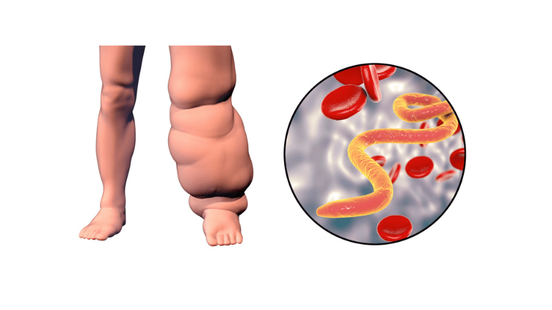 Ilustración de como se ve un linfedema en la pierna