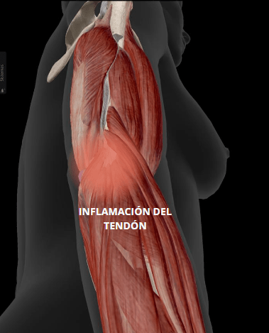 Ilustración de los musculos del brazo señalando la inflamación del tendón